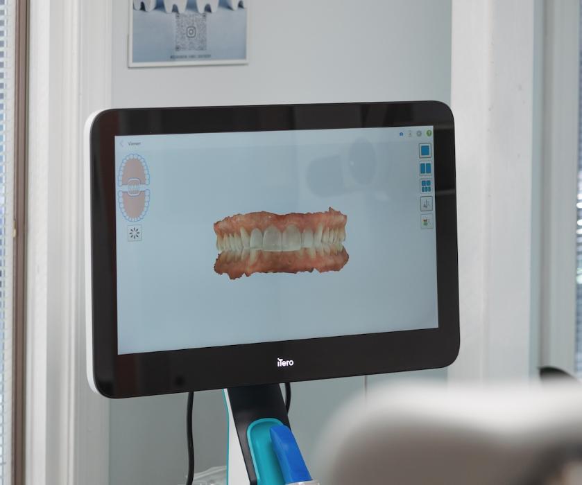 An image of a dental digital impression