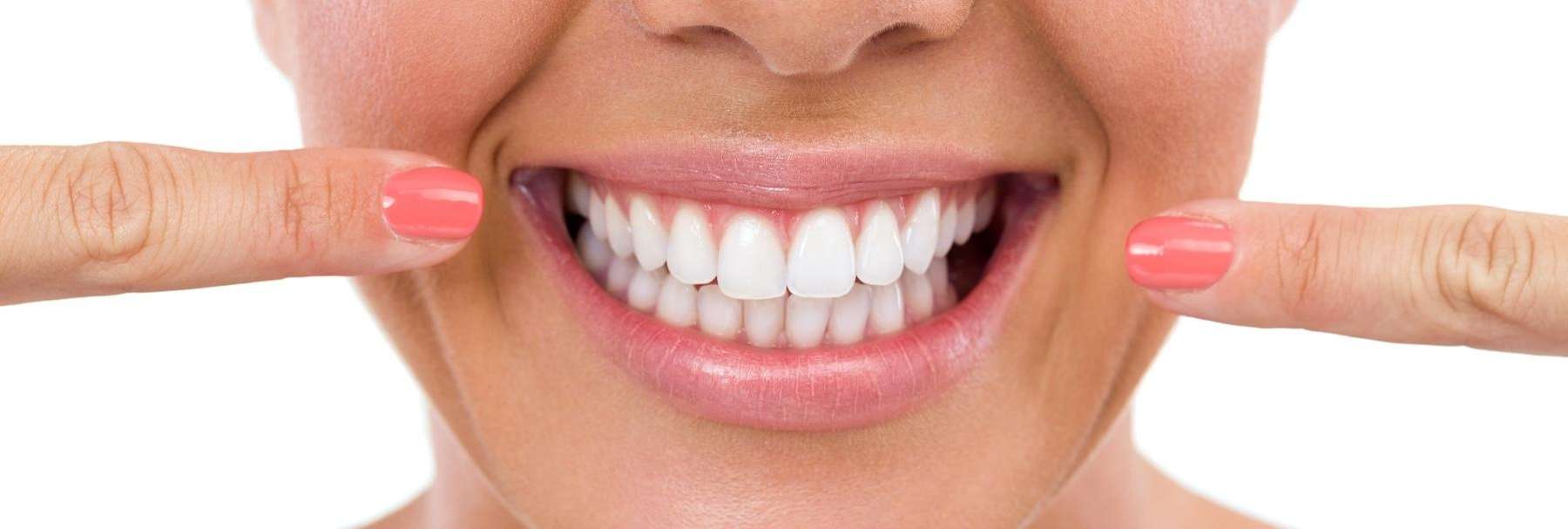 A woman with veneers smiling