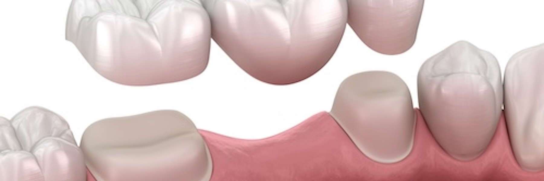 An illustration of a dental bridge being placed