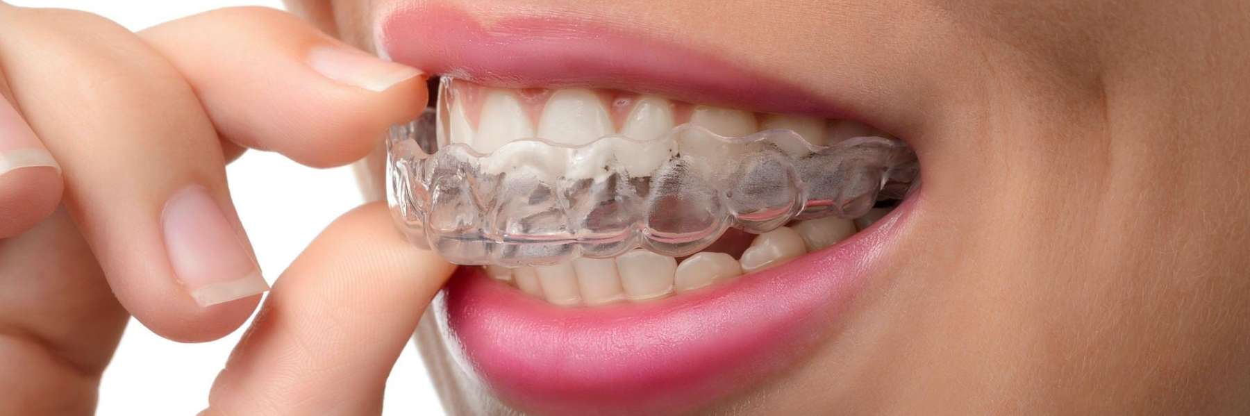 A smiling woman putting in her Invisalign tray | Arlington dentist