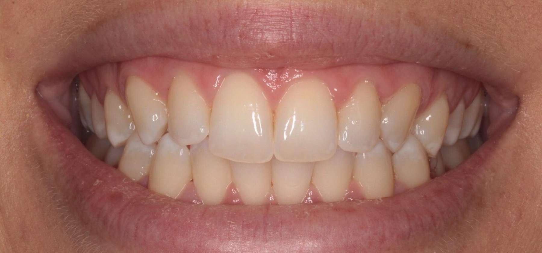 A large smile with straight and yellow teeth