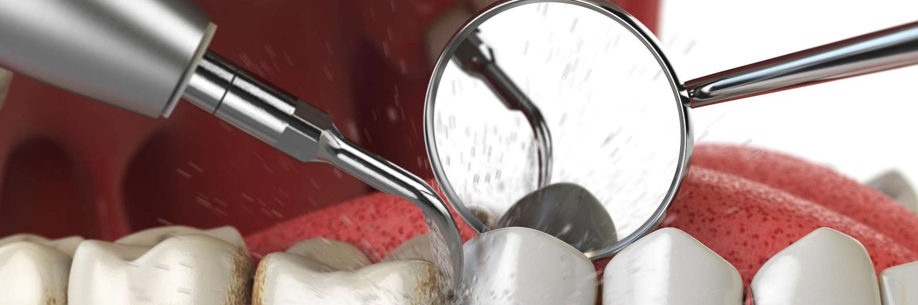 An illustration of a dental cleaning