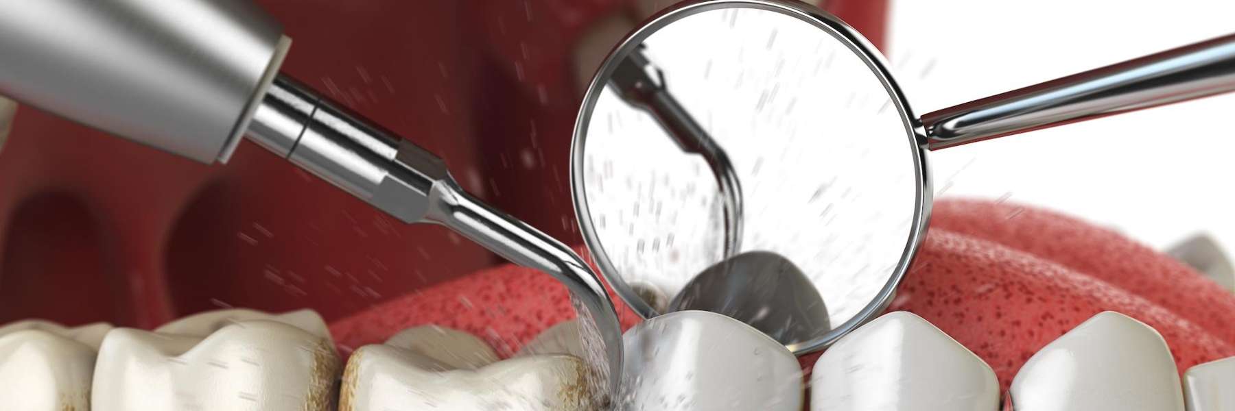 An illustration of a dental cleaning