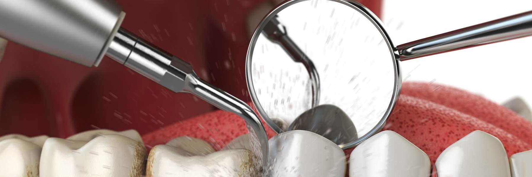 An illustration of a dental cleaning in Arlington